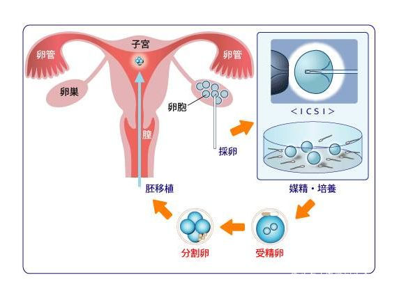 多囊卵巢综合征