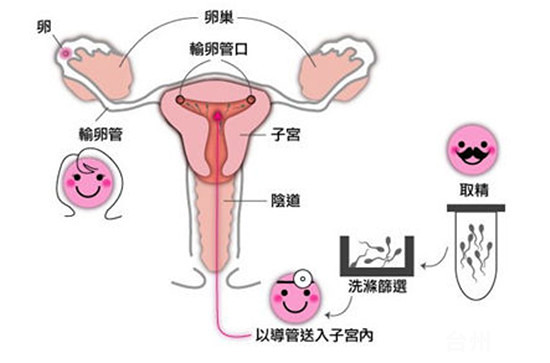 多囊卵巢综合征