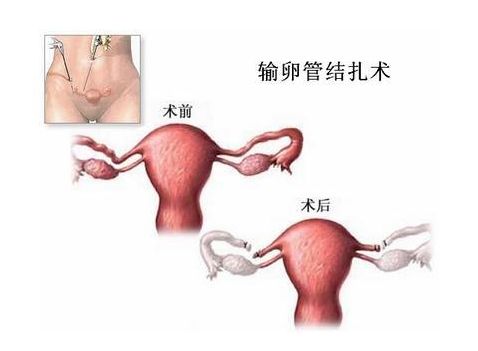 多囊卵巢综合征