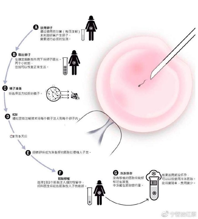 多囊卵巢综合征
