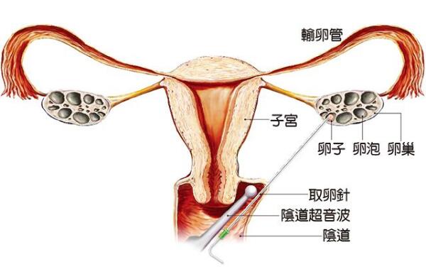多囊卵巢综合征
