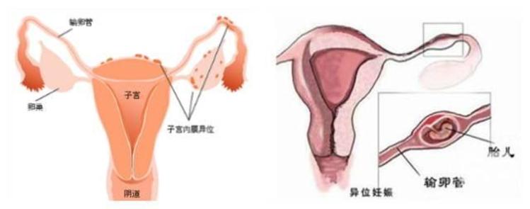 胚胎移植