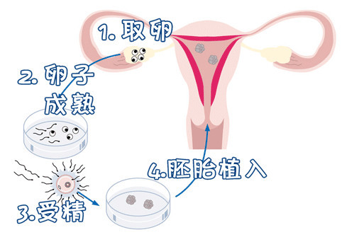 胚胎移植